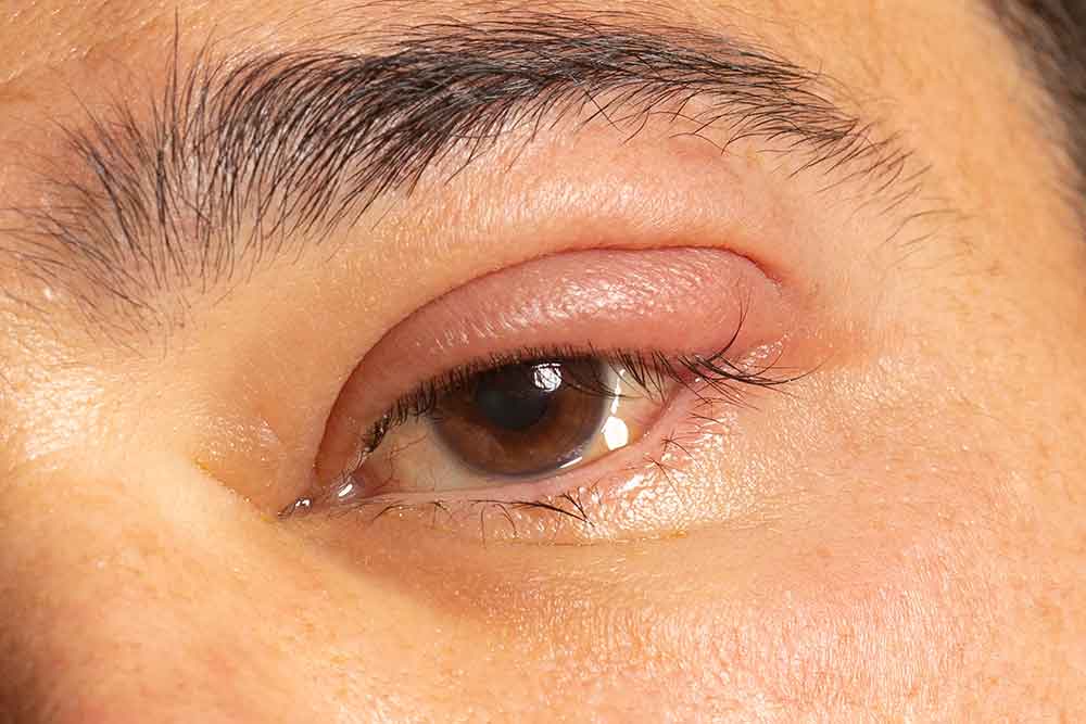 What is Eye Inflammation? What is Good for Eye Inflammation? - Veni ...