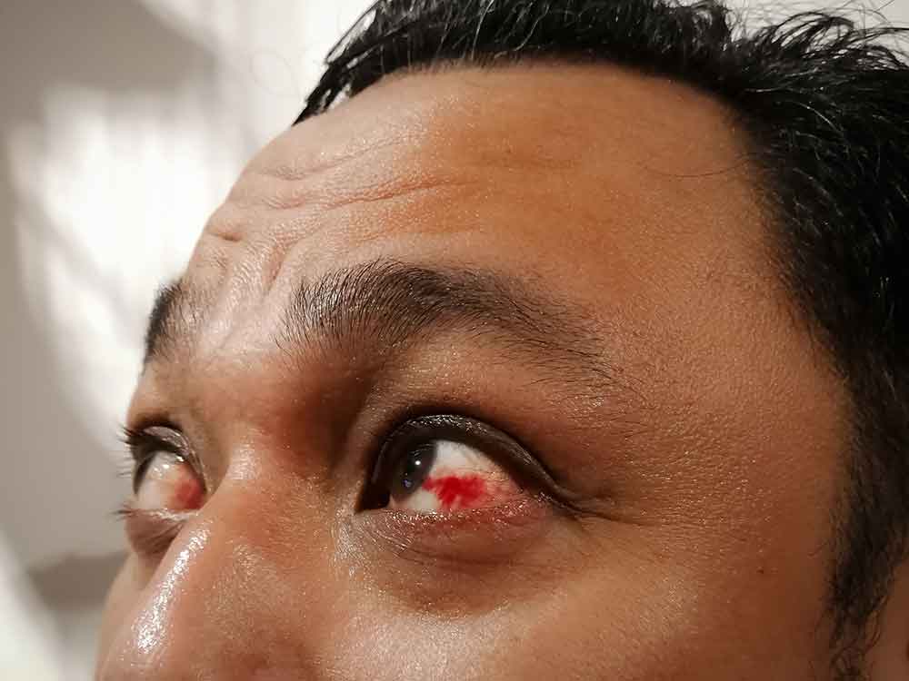 eye trauma