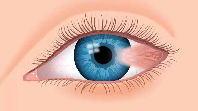 What is Pterygium? What are the symptoms and treatment? - Veni Vidi Eye