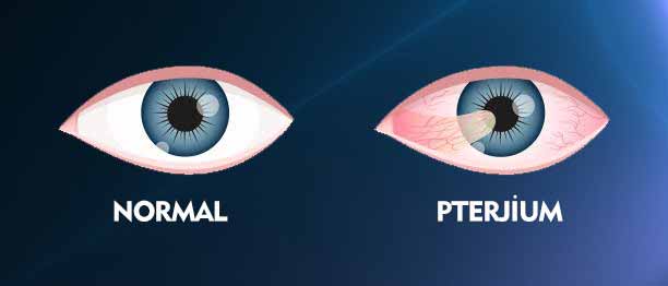 What is Pterygium? What are the symptoms and treatment? - Veni Vidi Eye